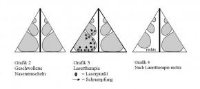 nasenatmung_laser_mehr_Nase Laservorgang